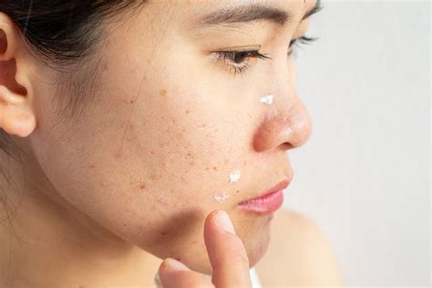 Understanding Acne-Prone Skin: Causes and Symptoms