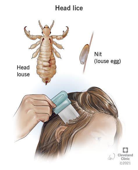 Understanding the Common Causes of Dreams about Discovering Lice in Your Sleeping Area