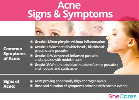 Understanding the Common Symptoms of Acne-Prone Skin