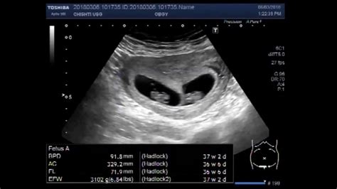 Understanding the Experience of a Twin Ultrasound Session