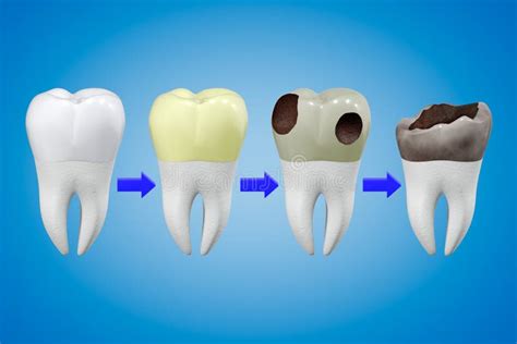 Unearthing Concealed Messages in Dreams of Dental Deterioration