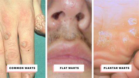 Unraveling the Mysterious Significance of Warts on Various Body Areas