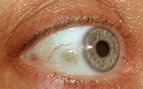 Unraveling the Origins: What Triggers Dreams of Eyeball Loss?