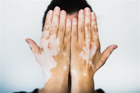 Unveiling the Secrets: Vitiligo and Other Skin Conditions