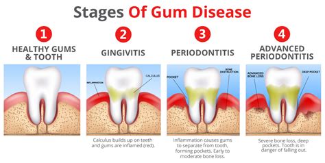 Unveiling the Telltale Signs of Gum Inflammation